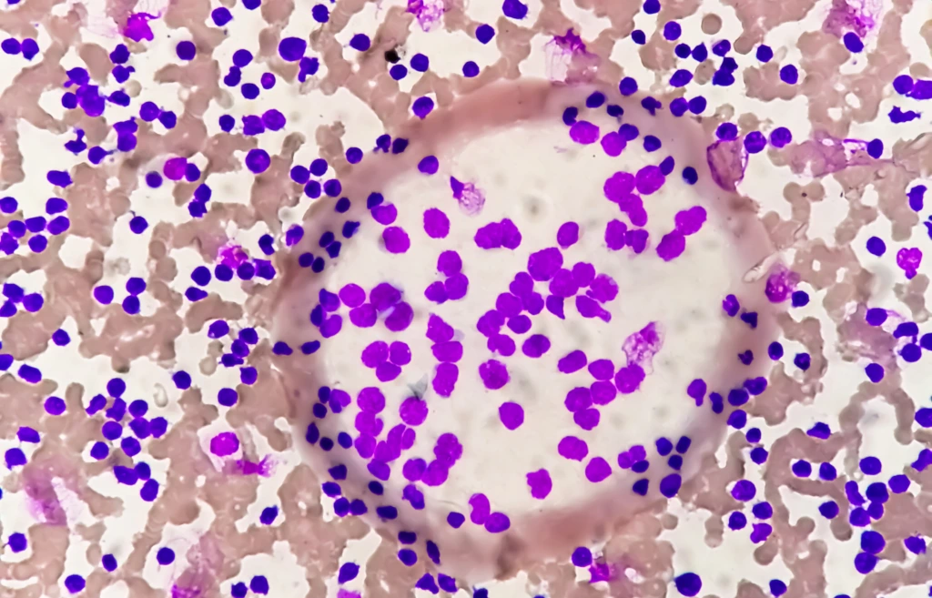 Blood,Smear,Under,Microscopy,Showing,Chronic,Lymphoblastic,Leukemia,(cll)