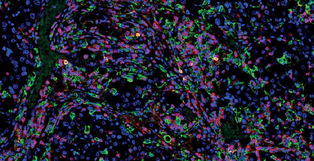 mIHC of NK cells phenotyping in NSCLC