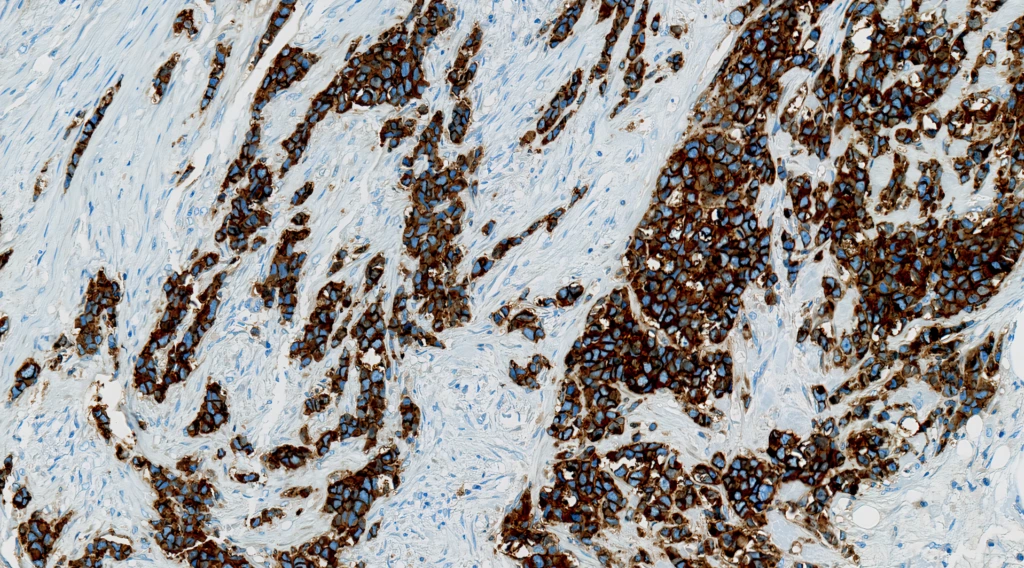 HercepTest™ mAB pharmDx Human Epidermal Growth Factor Receptor 2 (HER2) (Clone DG44) IHC staining of Gastric Cancer FFPE sample.