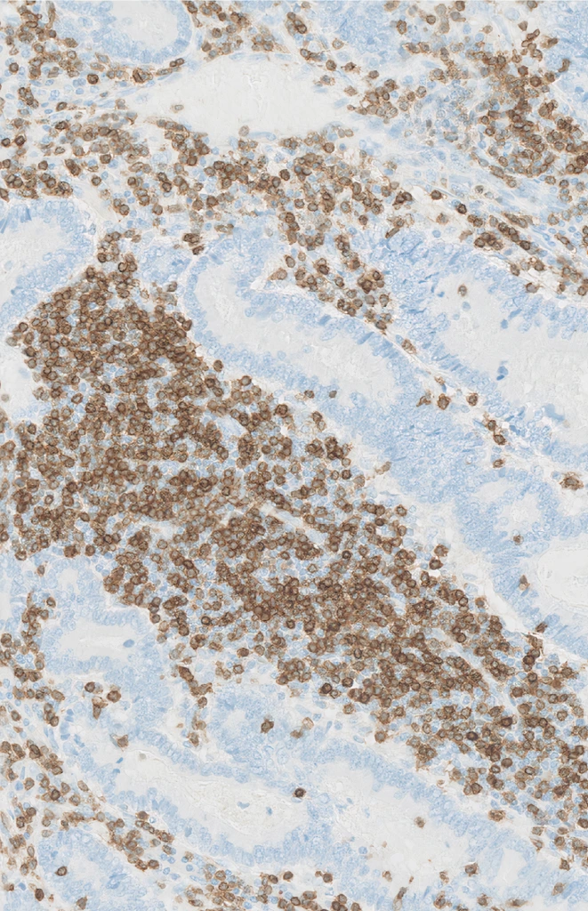 CD3 (Clone 2GV6) IHC staining of Colorectal Adenocarcinoma FFPE sample.