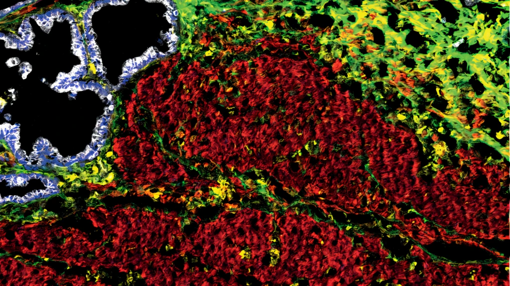Representative image of 4 targets in a 12plex. Alpha-SMA (Clone 1A4, Red), Vimentin (Clone RV202, Yellow), PanCK (Clone C11, White), Collagen I (Polyclonal, Lime green) multiplex IMC staining of Frozen Pancreas sample. Platform: Discovery ULTRA.
