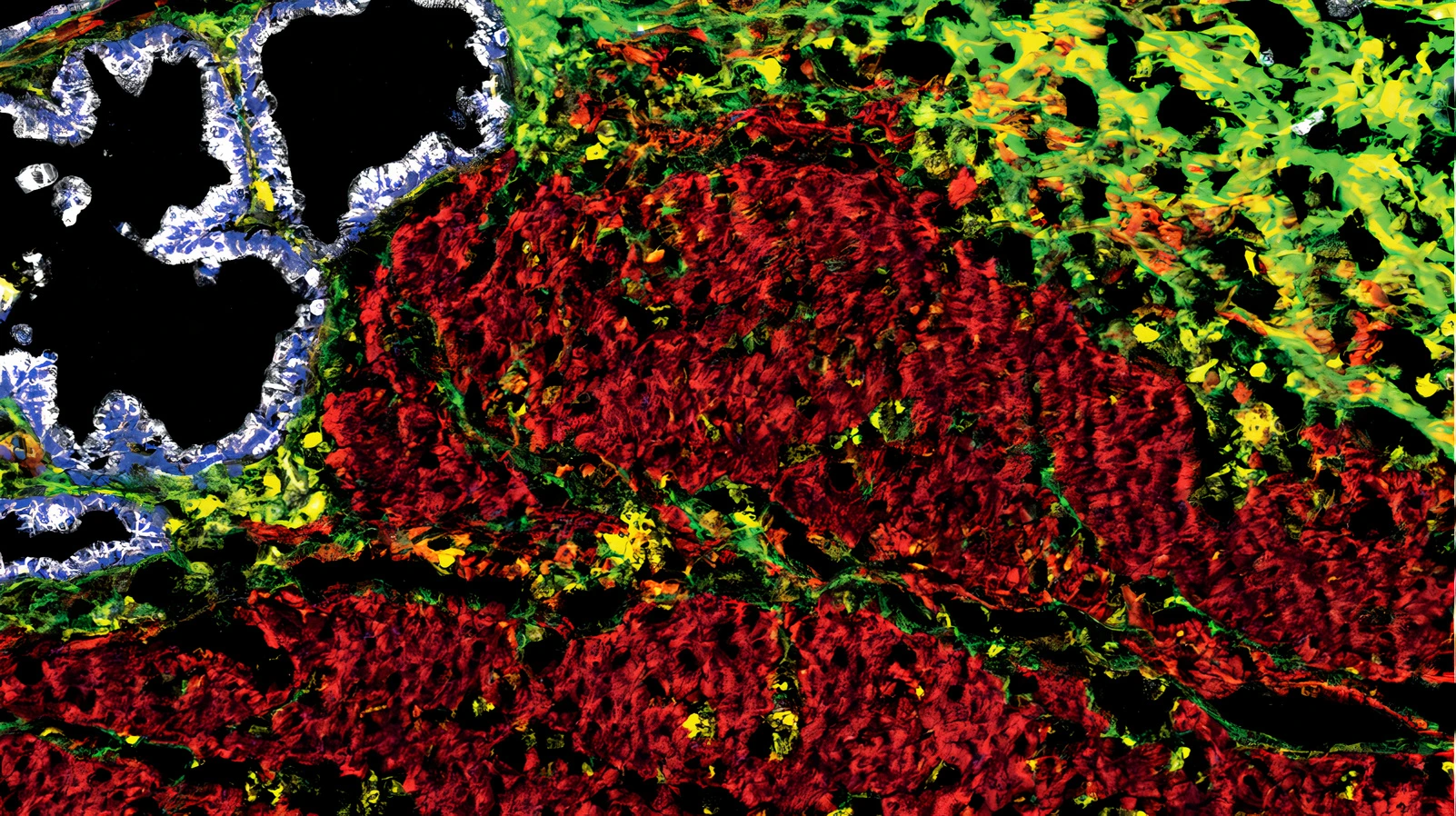Representative image of 4 targets in a 12plex. Alpha-SMA (Clone 1A4, Red), Vimentin (Clone RV202, Yellow), PanCK (Clone C11, White), Collagen I (Polyclonal, Lime green) multiplex IMC staining of Frozen Pancreas sample. Platform: Discovery ULTRA.