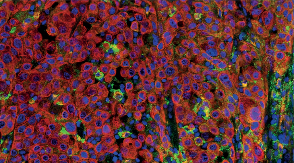 PanCK (Clone AE1/AE3, Red), CD68 (Clone KP1, Orange) and PD-L1 (Clone E1L3N, Green) multiplex IHC staining of Non-Small Cell Lung Cancer FFPE sample