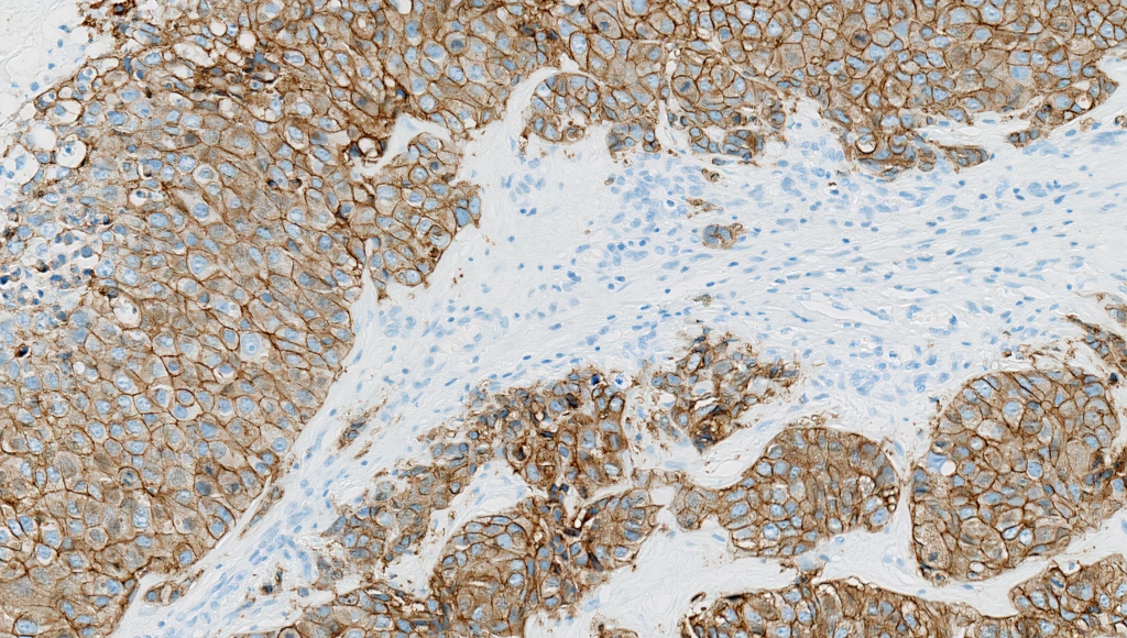 Human Epidermal Growth Factor Receptor 2 (HER2) (Clone 4B5) IHC staining of Breast Cancer FFPE sample.