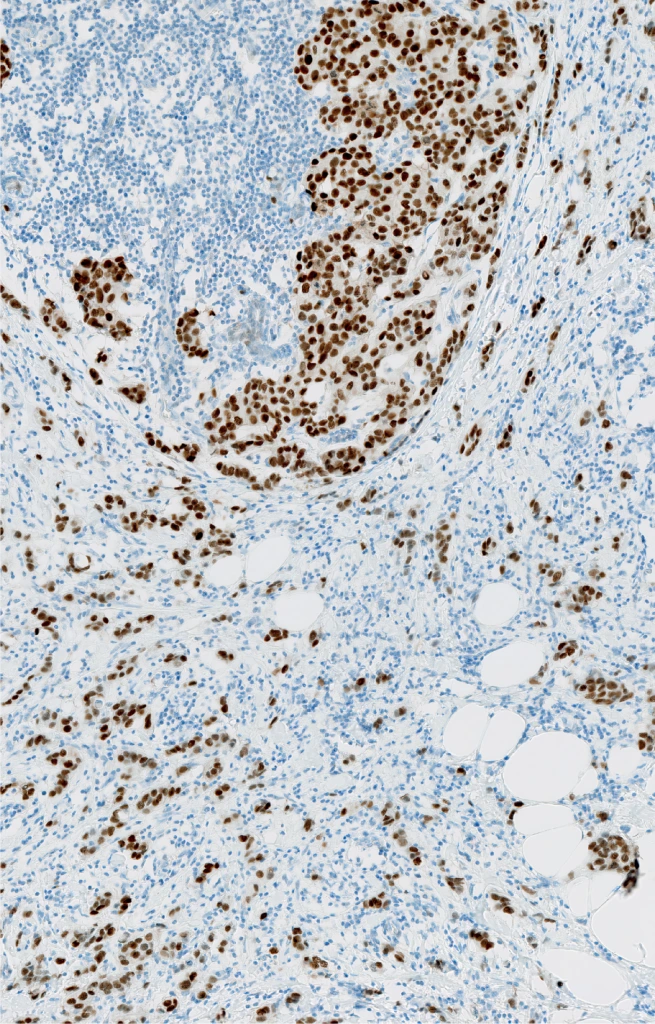 Estrogene Receptor (ER) (Clone SP1) IHC staining of Breast Cancer FFPE sample.