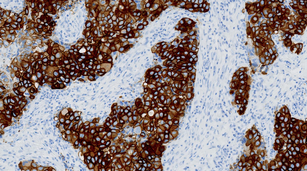 HercepTest™ mAB pharmDx Human Epidermal Growth Factor Receptor 2 (HER2) (Clone DG44) IHC staining of Breast Cancer FFPE sample.