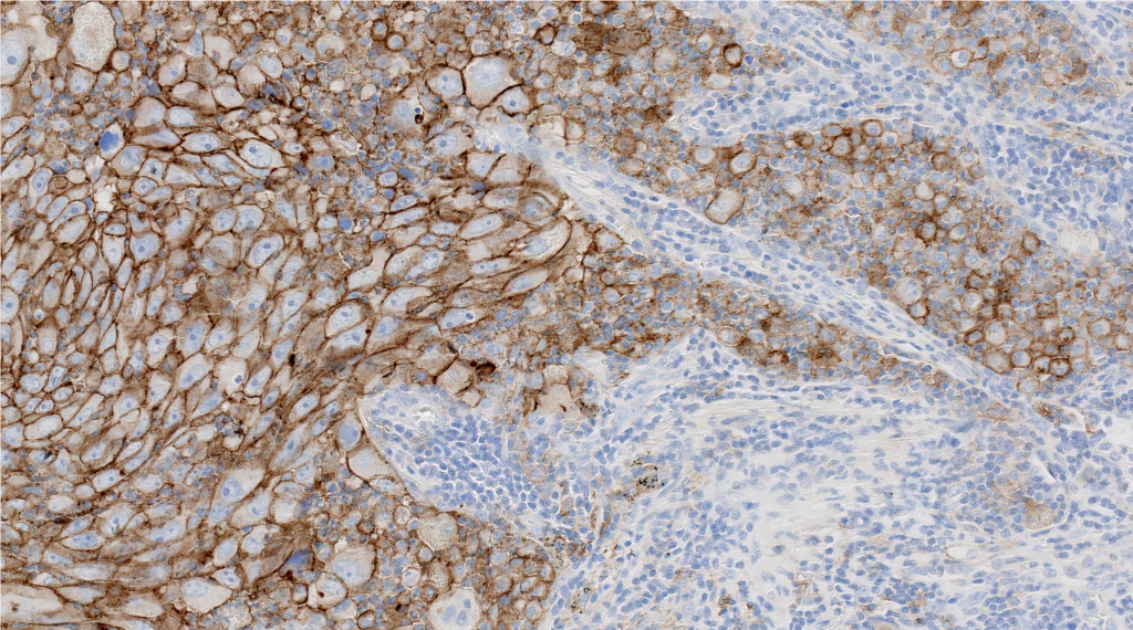 PD-L1 IHC 22C3 pharmDx (Clone 22C3) IHC staining of Non-Small Cell Lung Cancer FFPE sample.