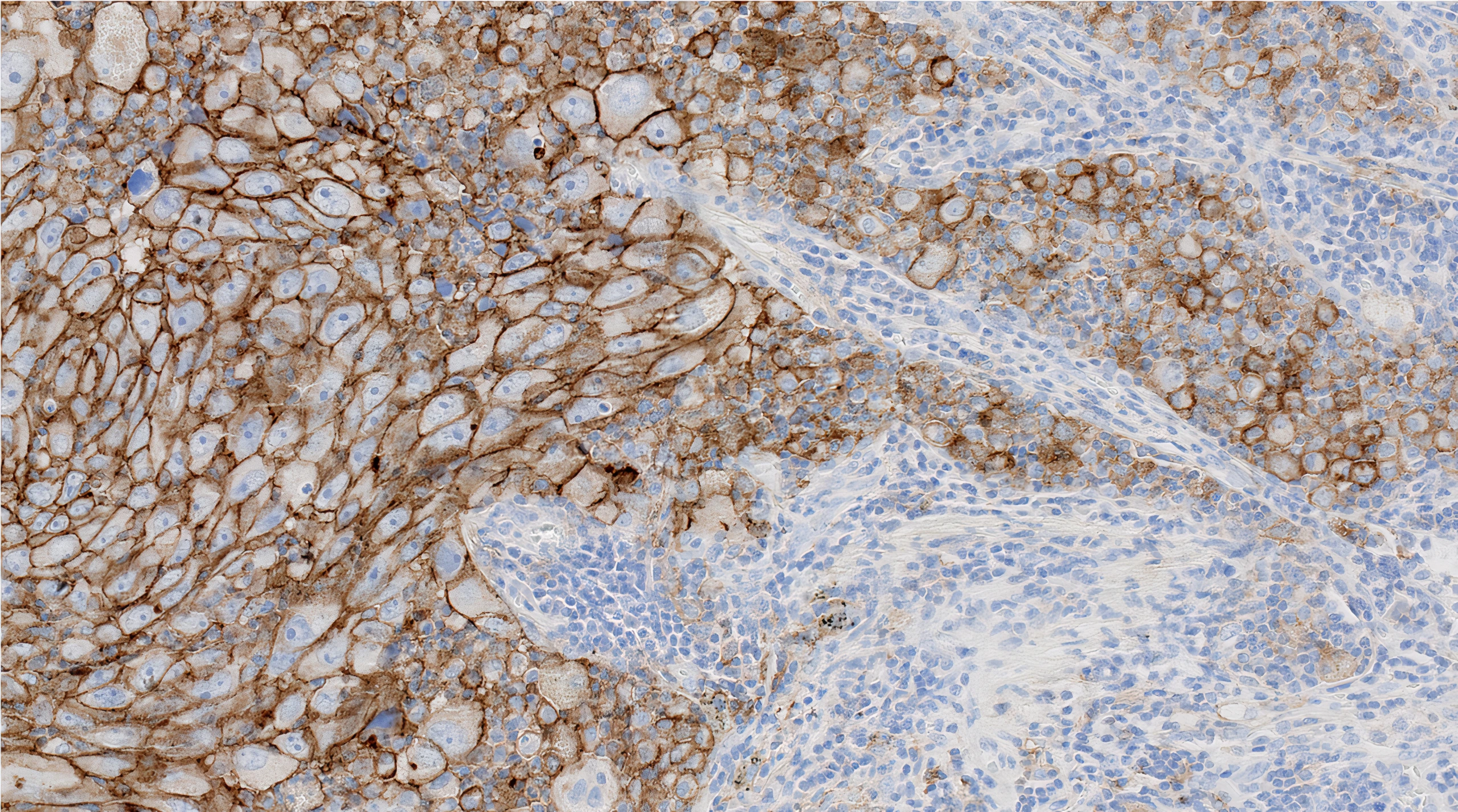 PD-L1 IHC 22C3 pharmDx (Clone 22C3) IHC staining of Non-Small Cell Lung Cancer FFPE sample.