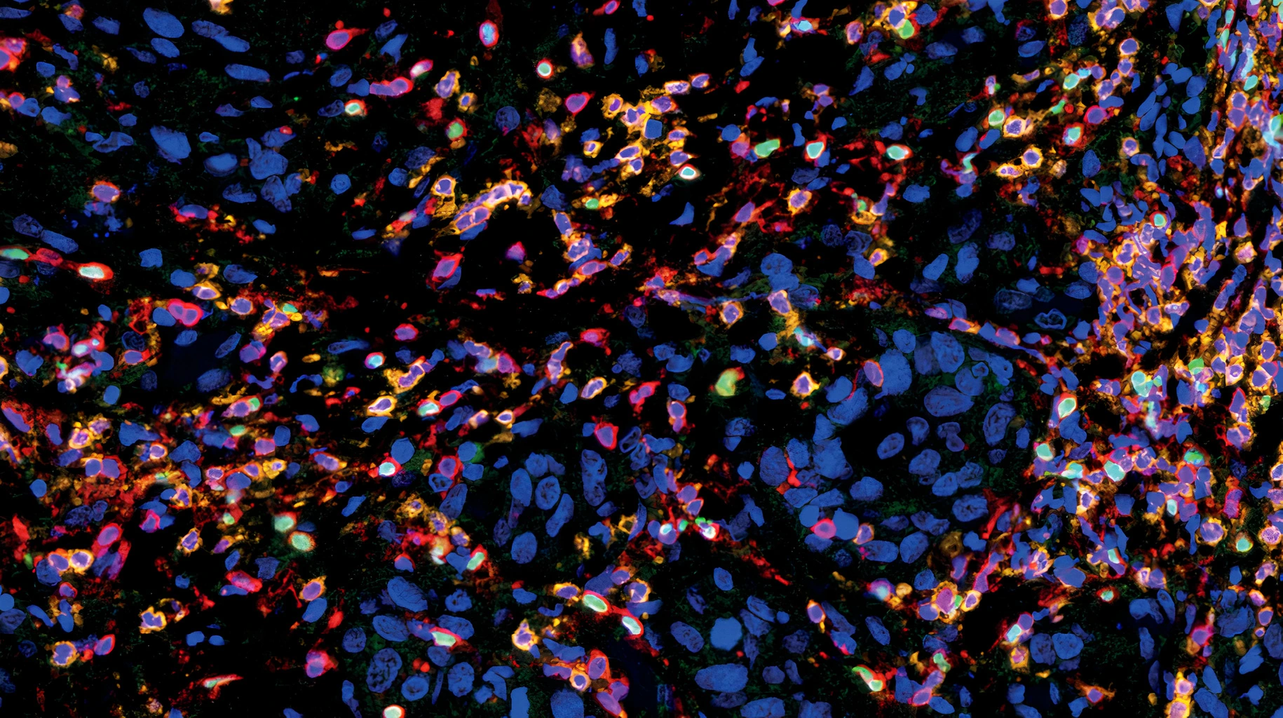 CD3 (Clone 2GV6, Red), CD8 (Clone AMC908, Orange) and FoxP3 (Clone 236A/E7, Green) multiplex IHC staining of Head and Neck Squamous Cell Carcinoma FFPE sample. T-Cells are identified by CD3 staining, Cytotoxic and regulatory subpopulations are identified by CD8 and FoxP3 staining respectively.