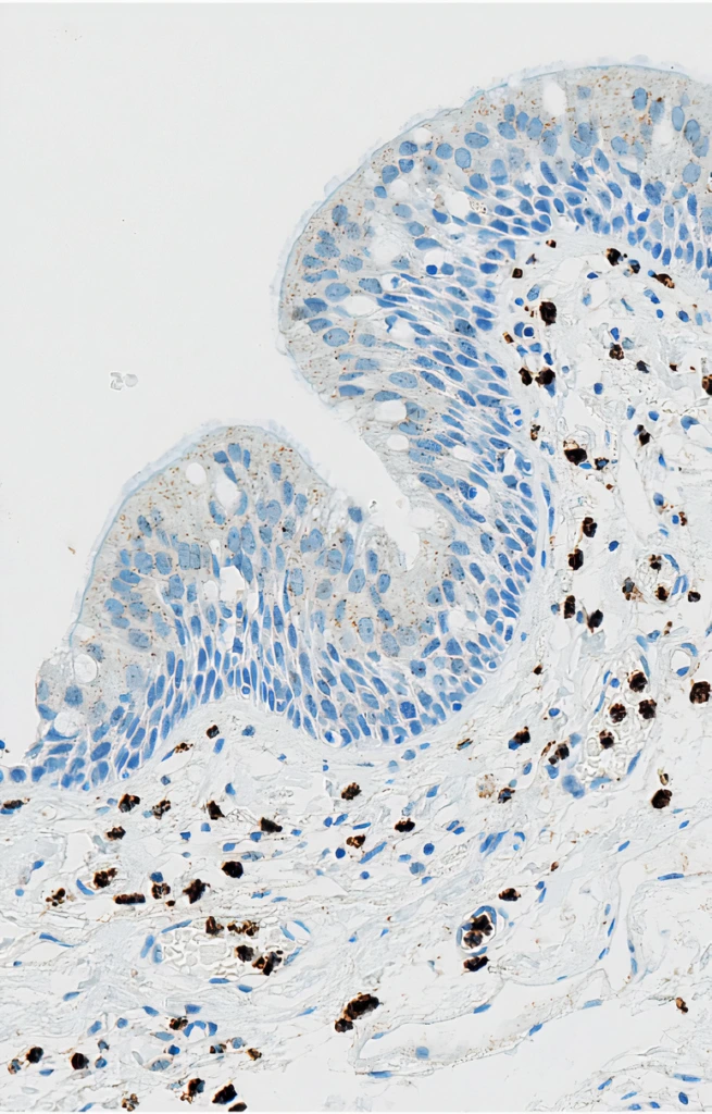 Neutrophil Elastase (Clone SP203) IHC  staining of Larynx Squamous Cell Carcinoma FFPE sample.