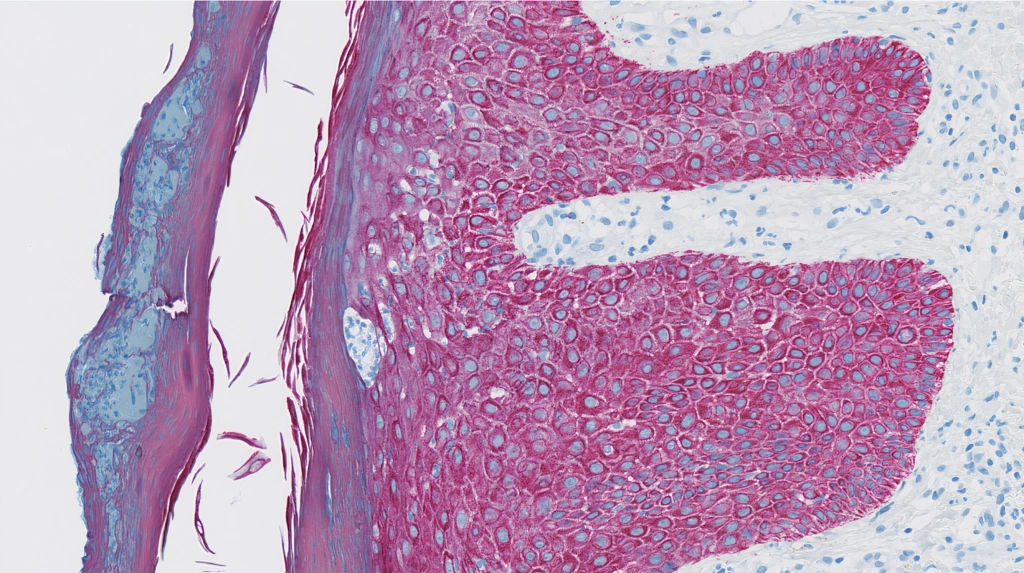 Cytokeratin16 (Clone EP297) IHC staining of Atopic Dermatitis Skin FFPE sample.