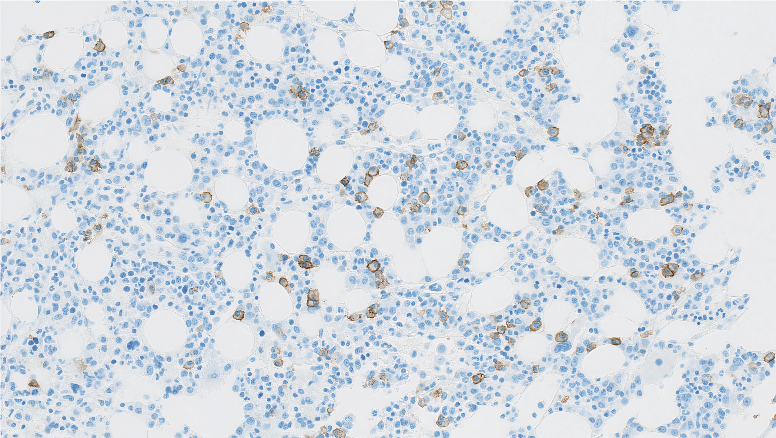 CD138 (Clone B-A38) IHC staining of Inflammatory Bone Marrow FFPE sample.