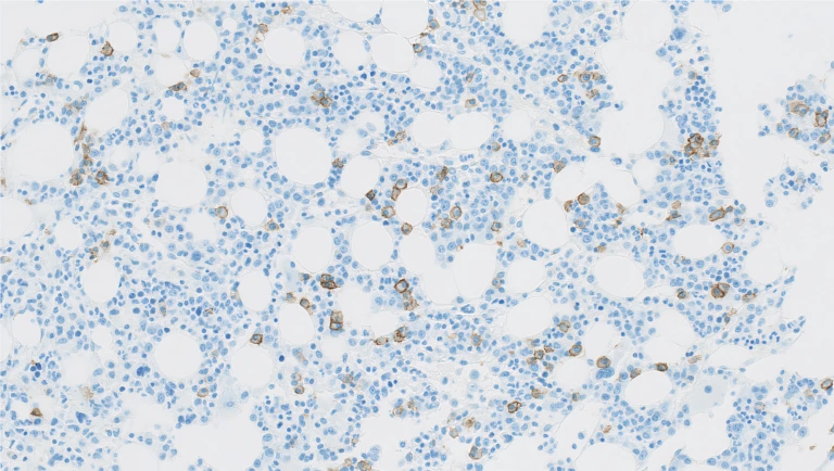 CD138 (Clone B-A38) IHC staining of Inflammatory Bone Marrow FFPE sample.