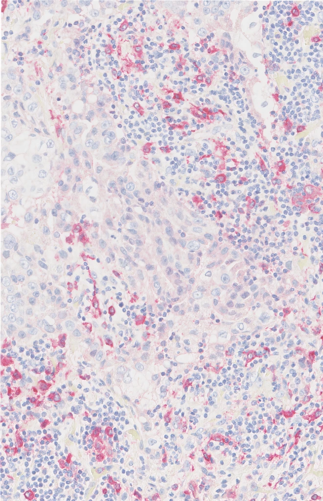 CD163 (Clone EDHu-1) IHC staining of Non-Small Cell Lung Cancer FFPE sample.