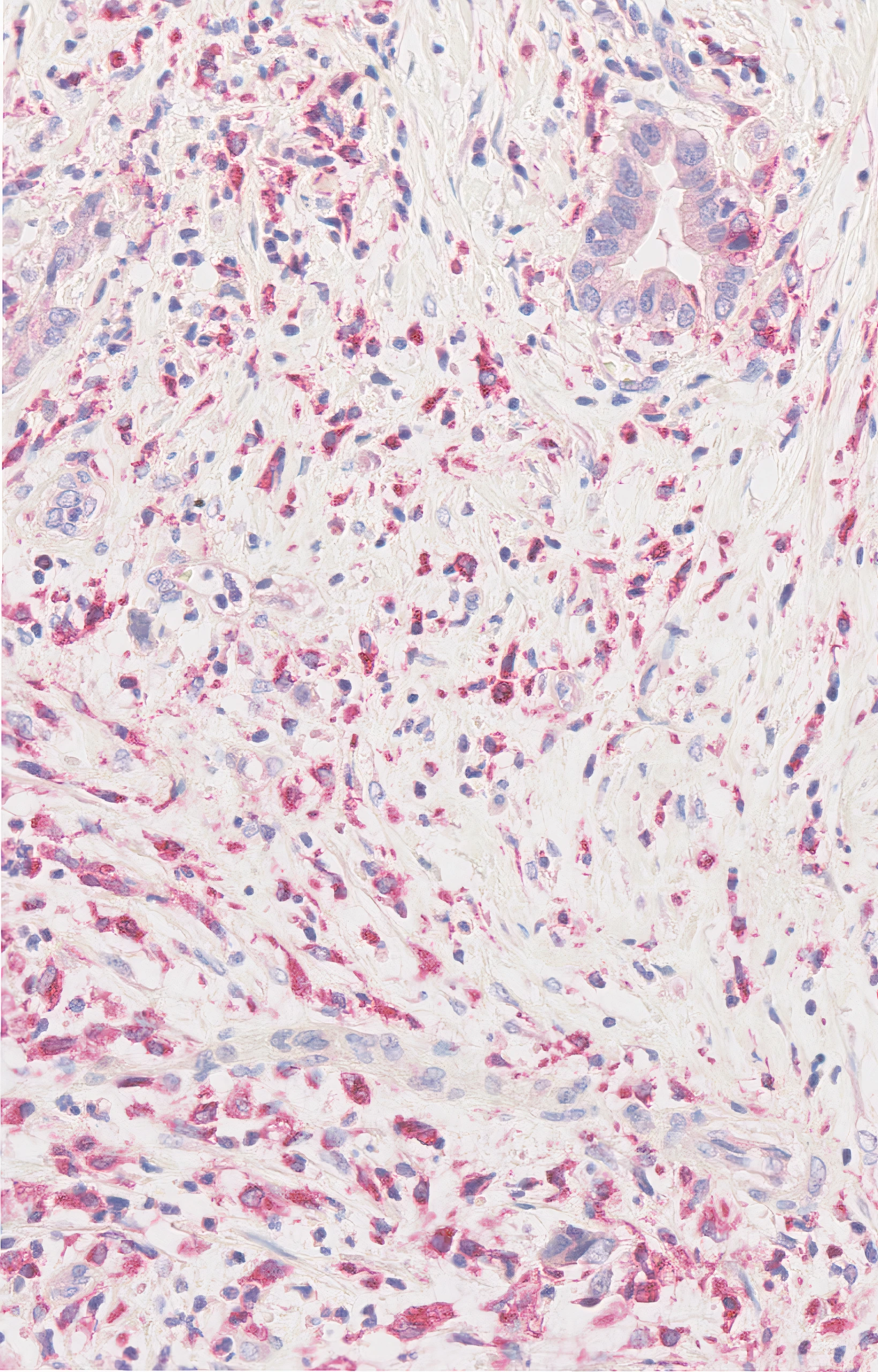 CD68 (Clone KP1) IHC staining of Non-Small Cell Lung Cancer FFPE sample.