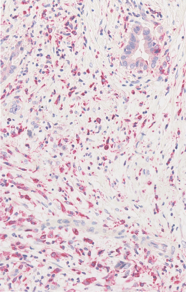 CD68 (Clone KP1) IHC staining of Non-Small Cell Lung Cancer FFPE sample.