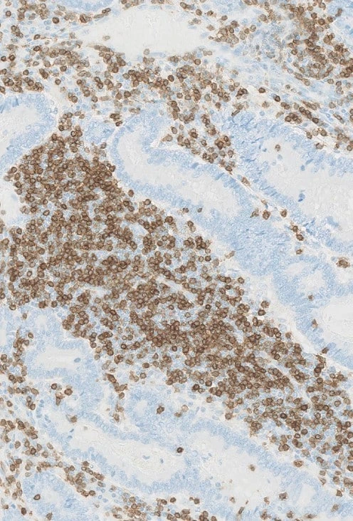CD3-IHC-staining-of-colorectal