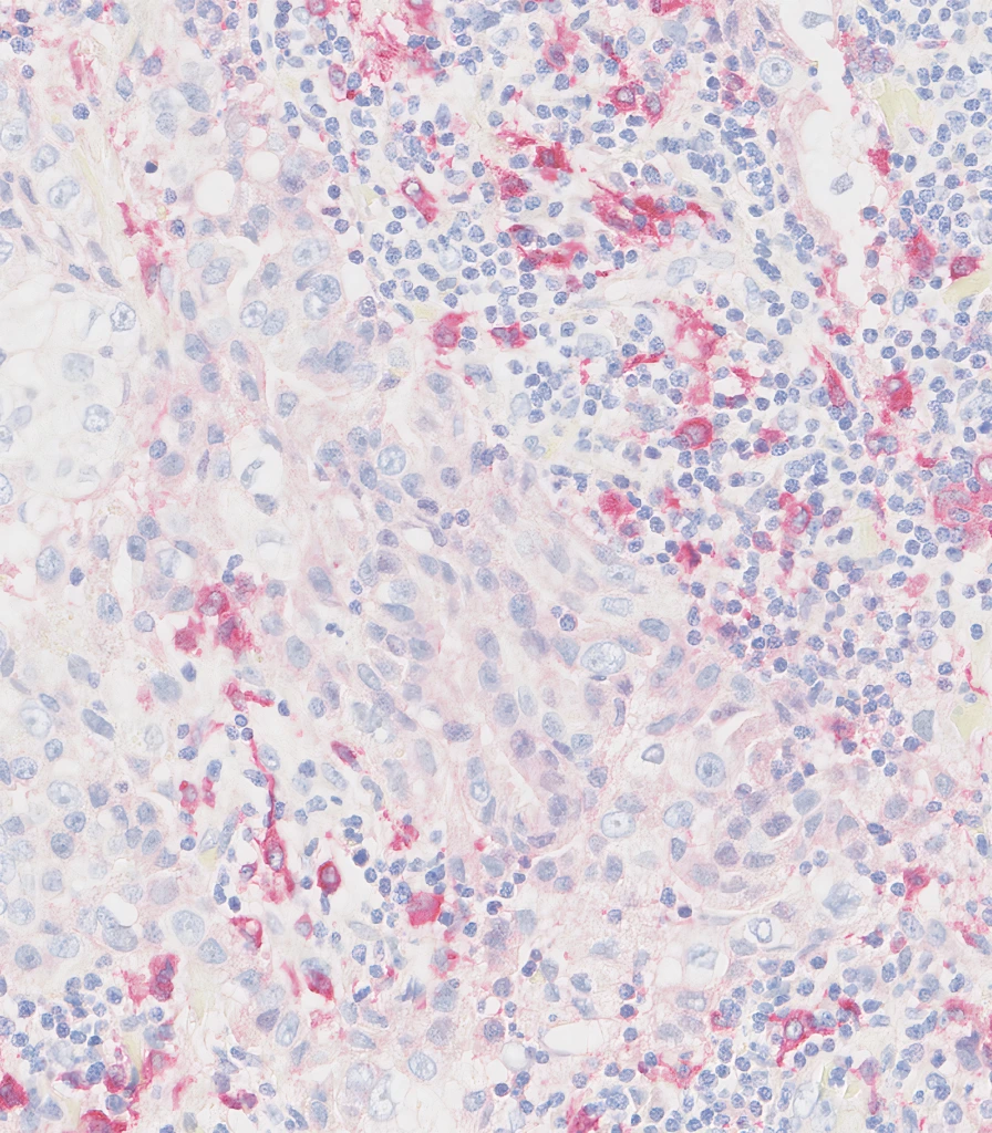Lung-Cancer