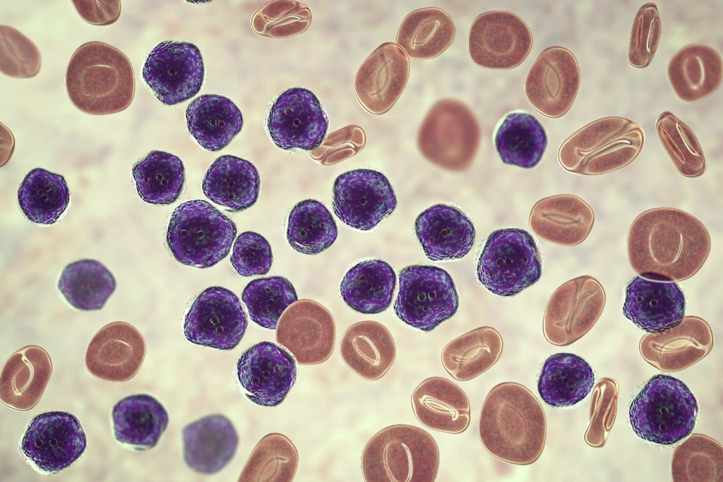 Acute,Lymphoblastic,Leukemia,,Bone,Marrow,Smear,,3d,Illustration